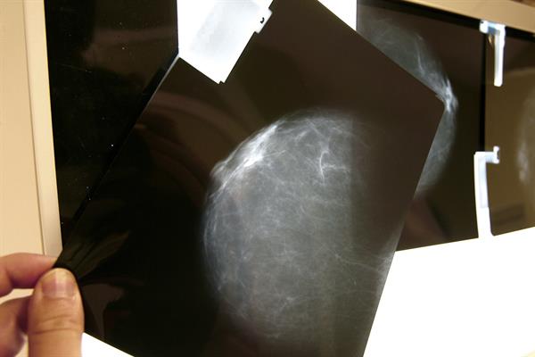 El cáncer de mama en cifras: ¿cómo enfrentar el alarmante pronóstico de la IARC?
