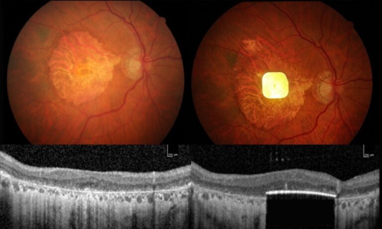 Una prótesis ocular permite leer a personas con ceguera irreversible Una prótesis ocular permite leer a personas con ceguera irreversible