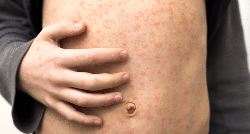 The New Jersey Department of Health (NJDOH) is alerting residents about a confirmed case of measles