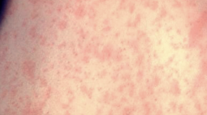 Screenshot 2025-08-22 at 10.11.44 PM Measles rash