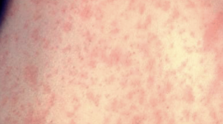NJ Health Department Alerts Residents of a New Confirmed Measles Case!